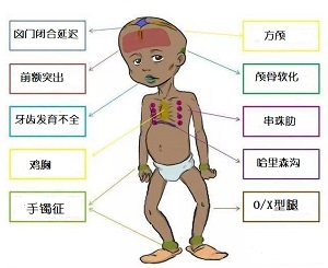 维生素D缺乏症状图片