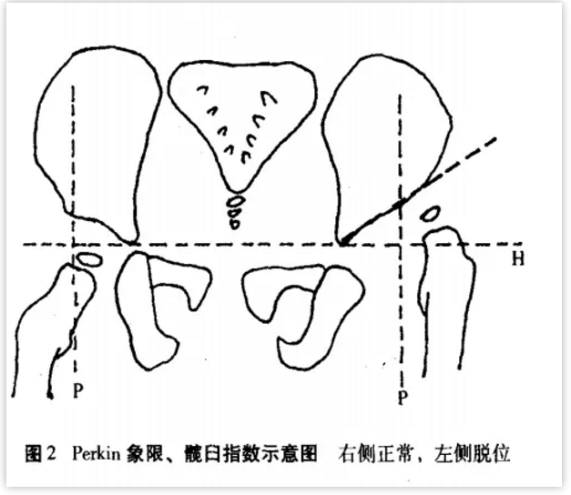 髋臼指数:正常值为20°~25°,当小儿步行后此角逐年减小,12岁时基本